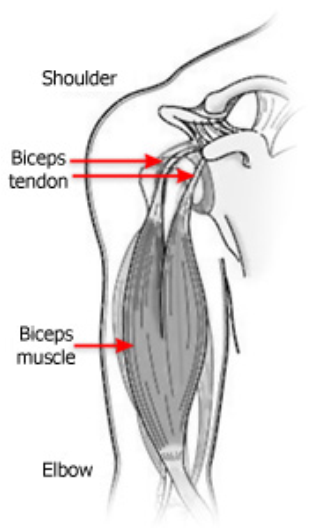 Biceps Tendinitis Dr Kandoi 3031